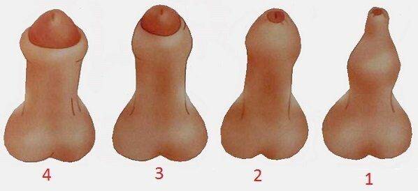 fimoz_u_malchikov_kak_vyglyadit__lechenie_v_domashnih_usloviyah__operaciya_1
