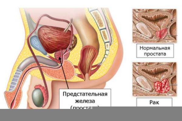 metastazy_pri_rake_predstatelnoy_zhelezy_i_ih_lokalizaciya_v_organizme_muzhchiny_1