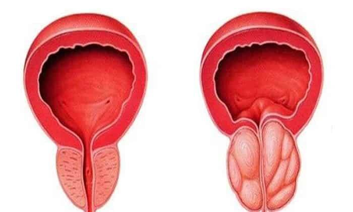 prostatit-2