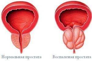 prostatit985894395-300x200-1-2