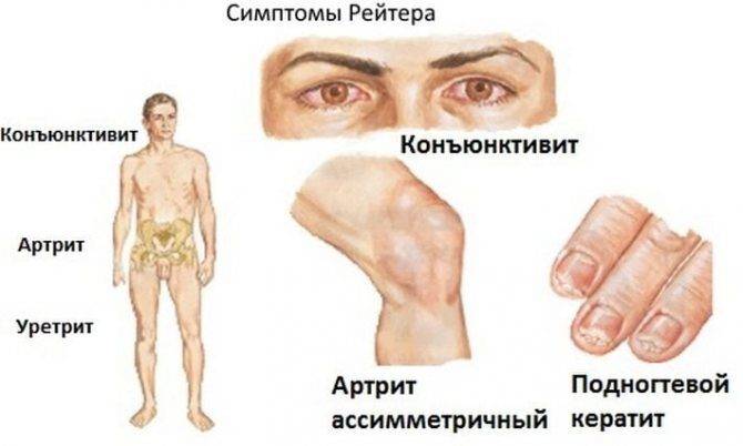 simptomy-bolezni-rejtera