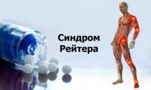 sindrom-rejtera-300x179-1